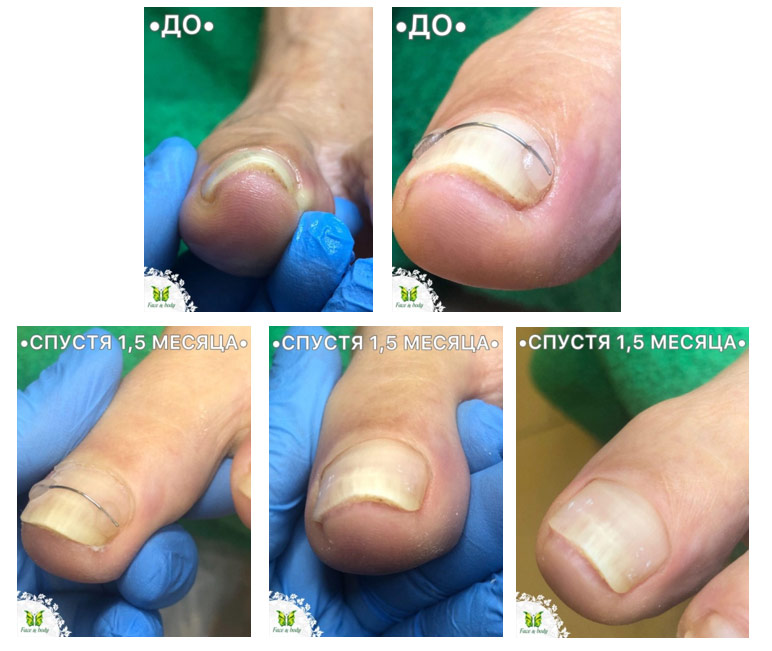 Установка скоб «Титановая нить» для лечения вросшего ногтя (процесс и результат). Пациенту потребовался один визит к подологу. После коррекции ноготь больше не давил на мягкие ткани.