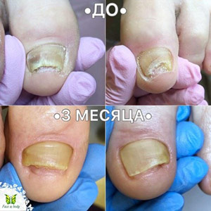 Процесс лечения вросшего и утолщенного ногтя. Результат спустя 3 месяца. 