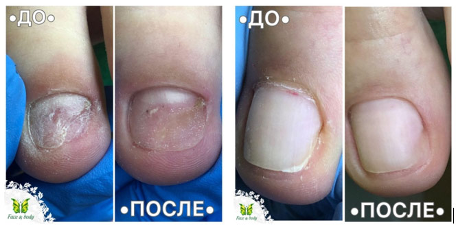 Частичное протезирование ногтя из акрилата препаратом Unguisan. Фото «до» и «после». 