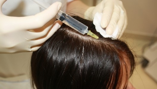 Мезотерапия волосистой части головы